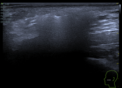 ultrasound hyaluronic acid filler silicone